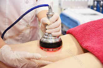 Rf skin tightening, belly. Hardware cosmetology. Body care. Non surgical body sculpting. Ultrasound cavitation body contouring tre