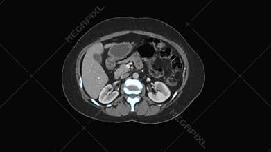 Medical MRI Scan monitor, CT or CAT scanner images