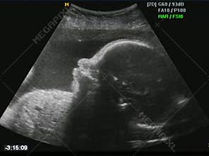 Fetus ultrasound