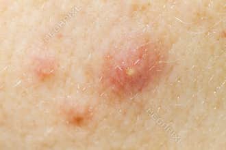 Face Acne Macro