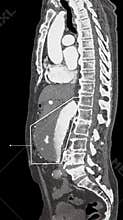 Abdominal Aortic Aneurism. Thrombus. CT-scan reconstruction