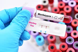 Monkeypox virus positive by using rapid diagnostic kit