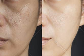 Two pictures compare effect Before and After treatment. skin with problems of freckles , pore , dull skin and wrinkles