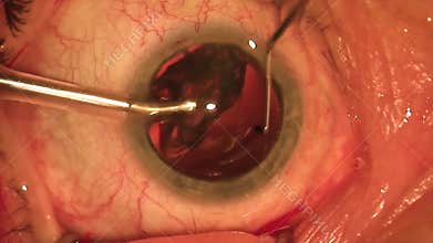 Cataract surgery. Intraocular lens implanted inside the eye.Ophthalmological surgery