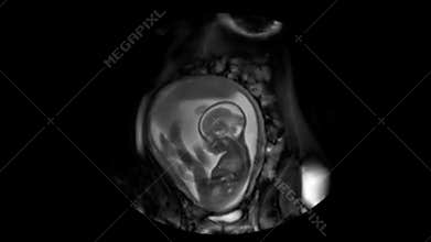 Ultrasonography of pregnant woman.  MRI of baby