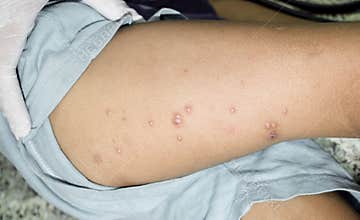 Small vesicles called molluscum contagiosum in the thigh