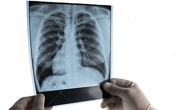 Human lungs x-ray on a white background  the doctor analyzes an x-ray of the lungs