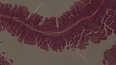 Peuz-Jaeger polyp growth at high magnification
