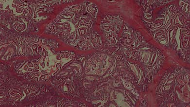 Peuz-Jaeger polyp growth at high magnification