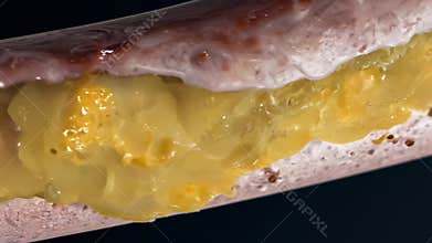 Cholesterol plaque building up inside artery