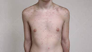 Teen with Chickenpox Rash