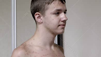 Man with Chickenpox