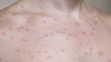 Chickenpox Blisters Close Up