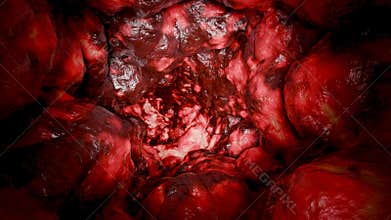 Colorectal cancer, malignant tumor in intestine, Endoscope colonoscopy, gut intestine, Colon polyp removal, inflammatory bowel
