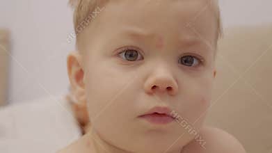 Child with early chickenpox symptoms showing on the face