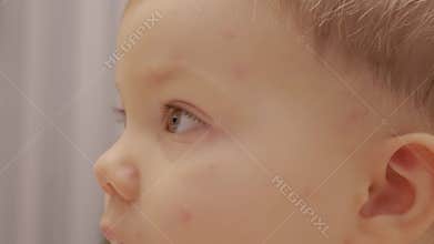 Child shows early signs of chickenpox with itching and rash on skin