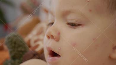 Child with chickenpox showing blisters on face during illness