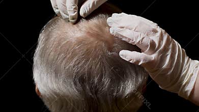 Hair Loss