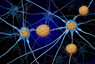 Tau Tangles And Amyloid Beta
