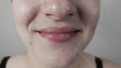 Woman's Gentle Smile with Problem Skin