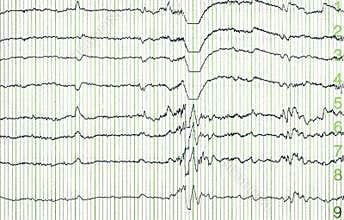 Electro-encephalogramme