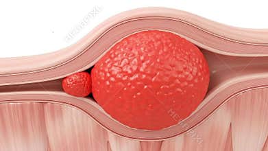 Close Up Of Medical Illustration Showing A Large Uterine Fibroid And A Smaller Polyp With Muscular Walls And Organic Texture In A