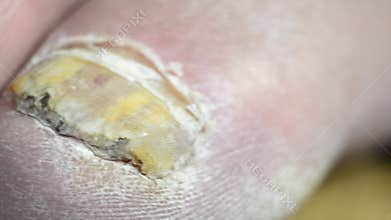 Toenails with common fungal infection