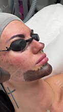 Young woman getting carbon laser facial at beauty clinic. Professional skincare