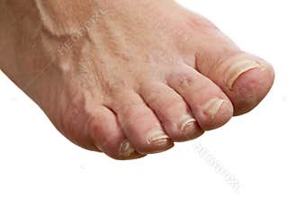 Isolated Diabetes Foot