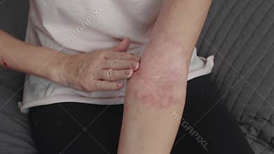 Woman applies a harmonious dermatitis ointment