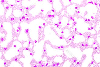 Blood picture of chronic lymphocytic leukemia or CLL