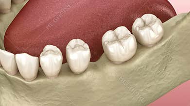 Teeth shift deformatiuon after losing molar tooth. 3D animation of Popov Godon phenomenon