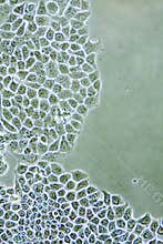 Ductal Breast Cancer cells