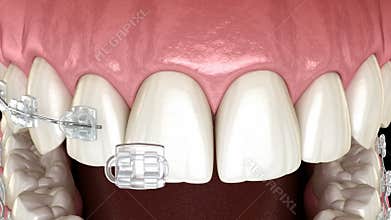 Clear braces instalation other teeth