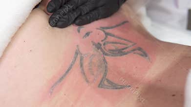 Removal of an old tattoo with a laser in an aesthetic medicine clinic.