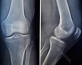 X-ray of a knee