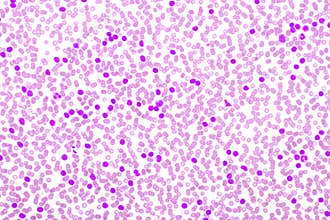 Picture of leukemia cells in blood smear