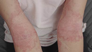 Allergic dermatitis on the elbows