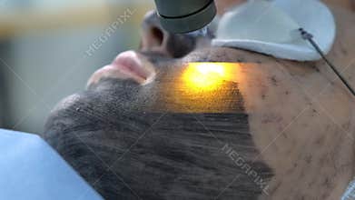 Portrait of woman on laser carbon face peeling procedure in beauty clinic.