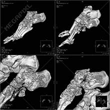 CT foot image