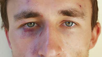 Portrait of a European man with bruises under his eyes