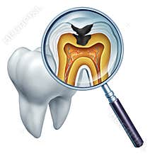 Tooth Cavity Close Up