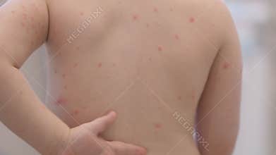 Back acne in adolescents a common skin condition chickenpox experienced by many teens today
