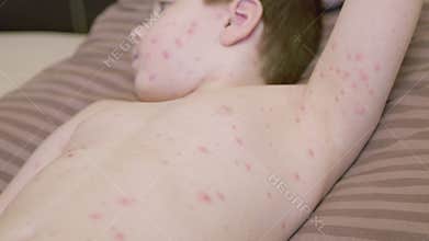 Young child with a skin rash chickenpox on their back is lying down, appearing uncomfortable and irritated