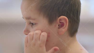 A Child with a Skin Condition chickenpox Profile Side View Displaying Unique Features and Symptoms