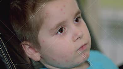 A Child with a Skin Condition chickenpox A Thoughtful Moment of Reflection and Contemplation