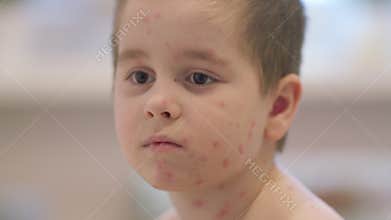 Child exhibiting symptoms associated with chickenpox, a contagious childhood disease