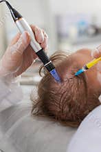 Trichologist doing man hair regeneration procedure dermapen microneedling vitamin exosomes injection