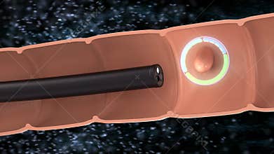 Endoscope with colonic polyp in intestine 4k footage