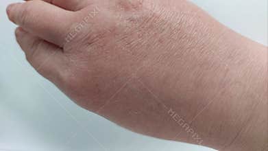 Detailed View of Aching, Flaky, and Reddened Hand Skin with Deep Cracks, Indicative of a Cold Allergy or Extreme Dryness